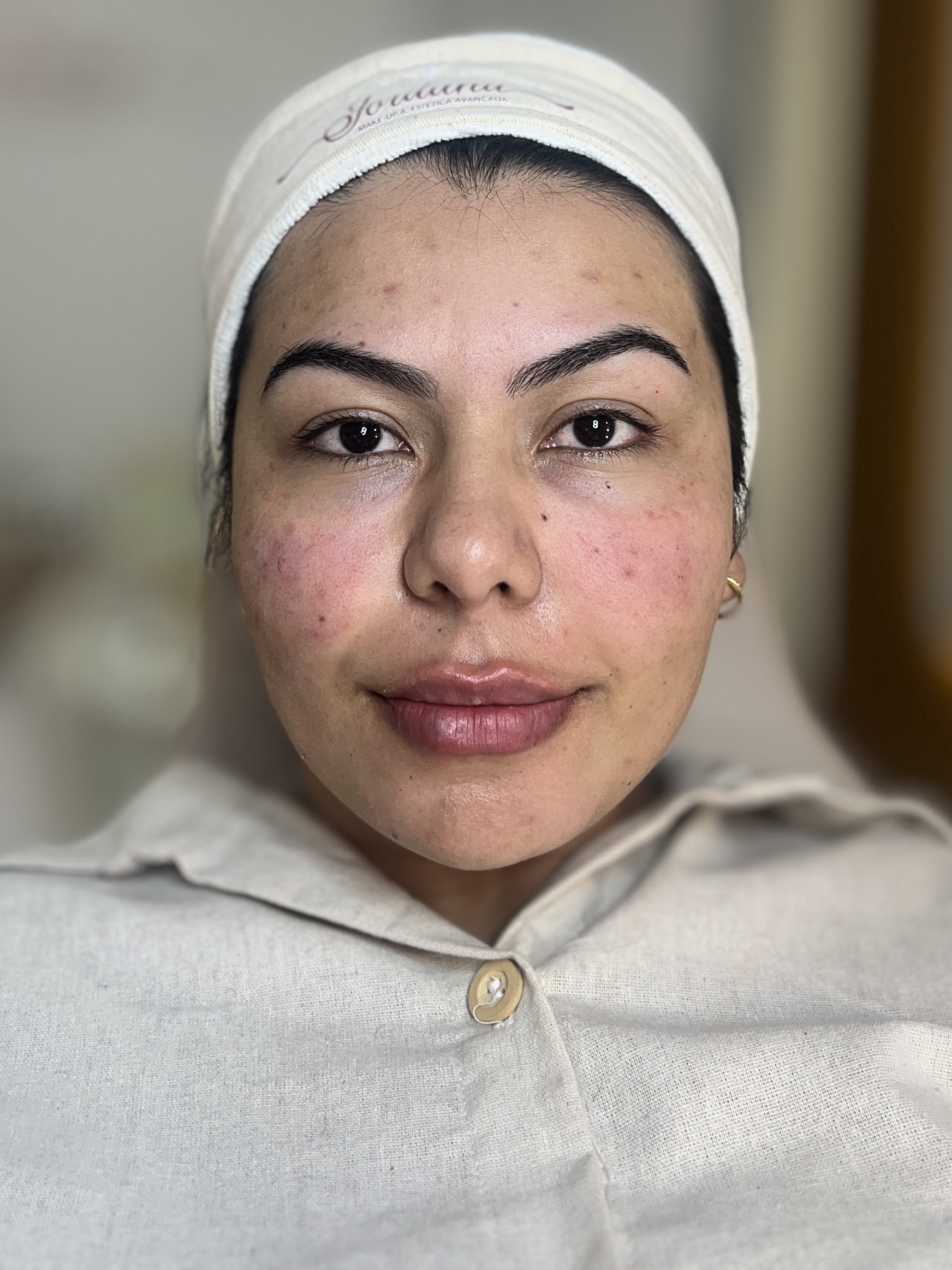 Clara depois da harmonização facial